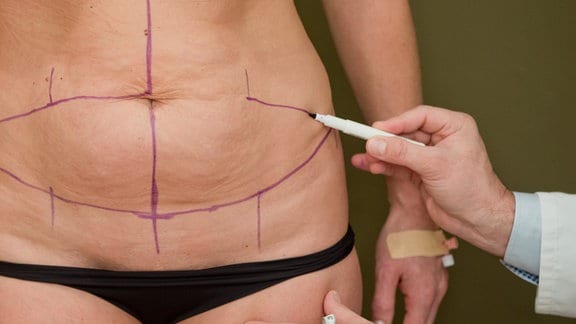 Ein Facharzt für plastisch-ästhetische Chirurgie zeichnet Markierungen fuer eine Bauchdeckenstraffung auf den Bauch einer Patientin.