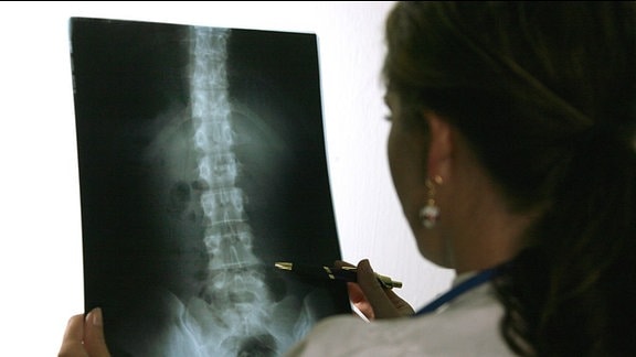 Osteoporose am Röntgenbild
