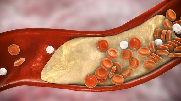 3D-Darstellung einer Arterie, an deren Wand sich ein Cholesterin-Plaque abgesetzt hat.