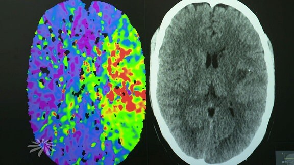 Scan eines Gehirns.