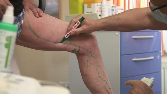 Ein Arzt zeichnet die Krampfadern auf dem Bein eines Patienten nach