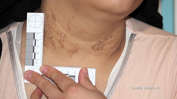 Am Hals einer Frau werden Würgespuren nachgewiesen.