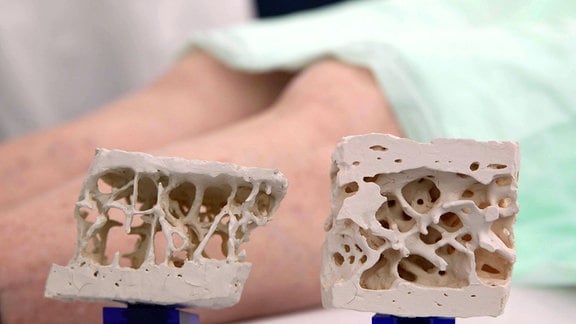Osteoporose Knochenmodell