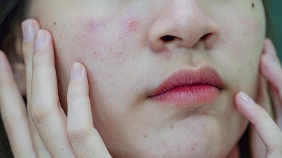 Akne-Pickel und Narben auf der Gesichtshaut