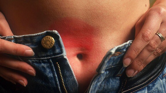 Frau mit Nickelallergie zeigt eine Rötung der Haut unter dem Knopf ihrer Jeans.