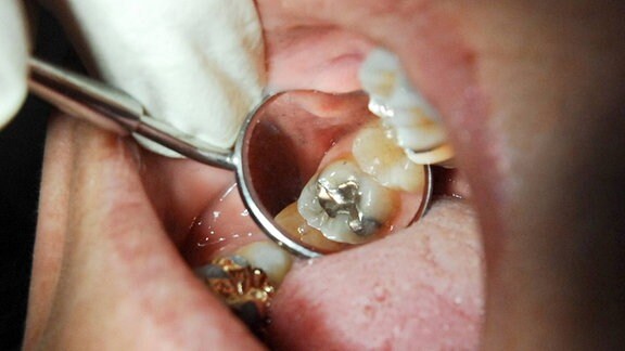 Zahnarzt untersucht bei einem Patienten eine Zahnfüllung aus Amalgam.