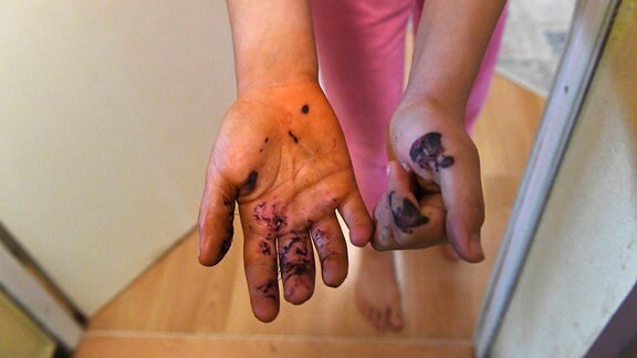Ein Mädchen zeigt durch einen Böller verursachte Verletzungen an den Händen