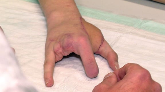 Jan Joneit verlor bei der Explosion eines illegalen Böllers zwei Finger seiner rechten Hand.