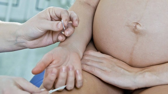 Während der Entbindung wird die Schwangere von ihrer Hebamme akupunktiert