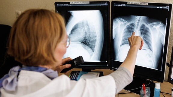 Foto zeigt ein Tuberkulose-Screening für Kriegsflüchtlinge aus der Ukraine. Eine Radiologin analysiert in ihrem  Büro in der Lungenklinik Gauting die Röntgenbilder der Lunge einer aus der Ukraine geflüchteten Person. 