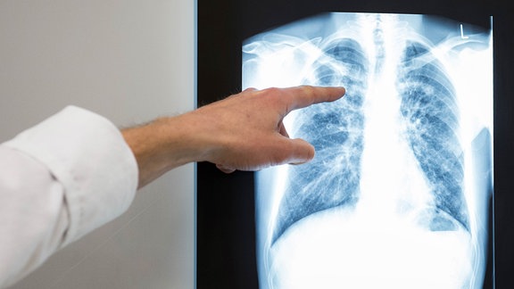 Ein Arzt zeigt auf das Röntgenbild einer Lunge. Es zeigt das typische Krankheitsbild.