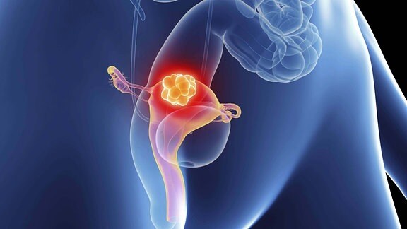 Symbolbild für Gebärmutterhalskrebs