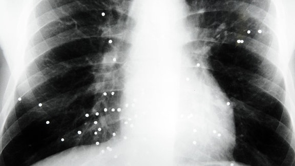 Röntgenbild eines Tuberkulosepatienten