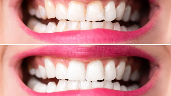 Bleaching - weiße Zähne