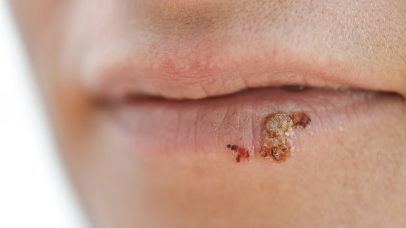 Frau mit Herpes simplex labialis an den Lippen