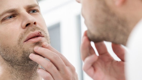 Mann mit Herpes an den Lippen betrachtet sich im Spiegel