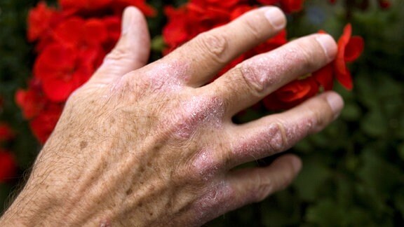Ein Mann mit Schuppenflechte oder Psoriasis richtet Blumen auf einem Balkon,