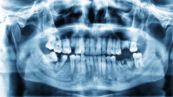 Ein Röntgenbild Zahnverlust