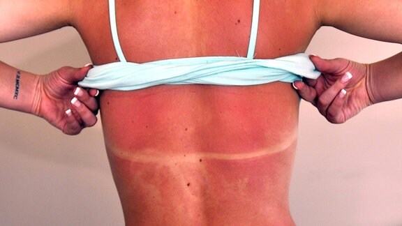 Eine Frau mit Sonnenbrand auf dem Rücken