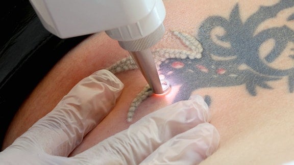 Tattoo-Entfernung mit einem Laser