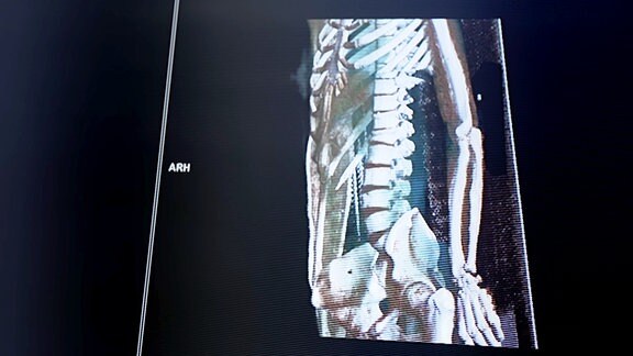 Computertomographie-Aufnahme eines Oberkörpers mit verletzter Wirbelsäule.