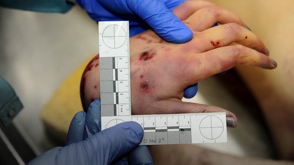 Hände in blauen Einmalhandschuhen messen mit einem Lineal tief blaue Verletzungen an der Hand einer Frauenleiche ab.