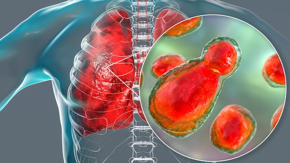 3D-Darstellung von mit Cryptococcus Hefepilz befallenem Lungengewebe in einem menschlichen Oberkörper