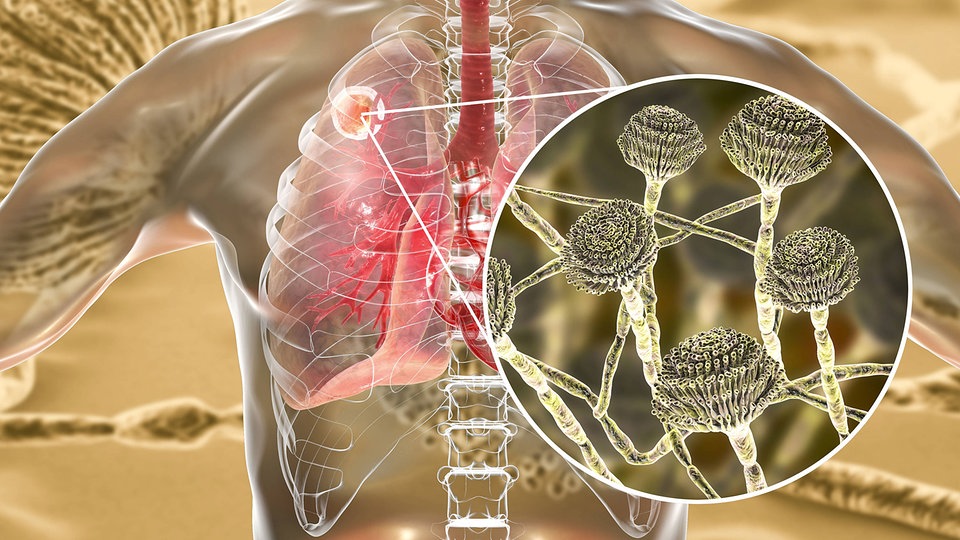 mold-spores-can-lodge-in-lung-cells