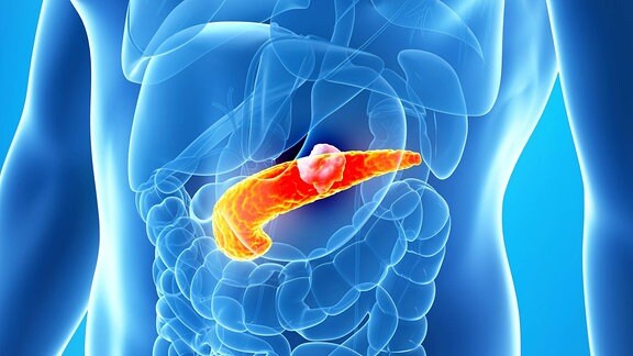 Grafik, Menschliche Bauchspeicheldrüse mit Tumor