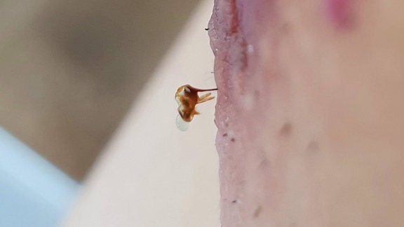 abgerissener Stachel einer Biene in der Brust eines Mannes