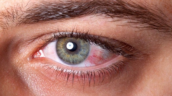 Nahaufnahme eines menschlichen Auges mit Bindehautentzündung.