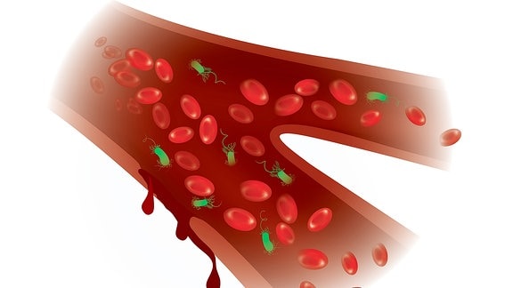 Illustration - Blutvergiftung Corona