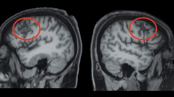 Anatomisches Bild vom Gehirn der Patientin, aufgenommen mithilfe der Magnetresonanztomographie. Die roten Kreise kennzeichnen die Läsionen auf beiden Hirnseiten, die durch die Schlaganfälle verursacht worden (L - linke Gehirnhälfte; R - rechte Gehirnhälfte).