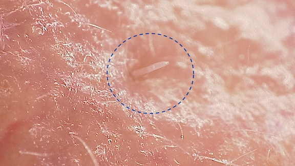 Stark vergrößerte Aufnahme einer Haarbalgmilbe Demodex folliculorum auf der menschlichen Haut