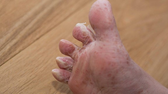 Fuß häutet sich nach viraler Hautkrankheit 