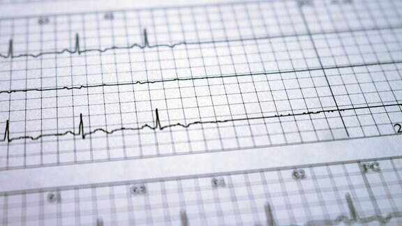 EKG Herzstillstand