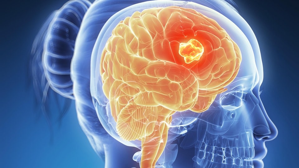 MDR WISSEN News: A cancer vaccine kills brain tumors and prevents them at the same time