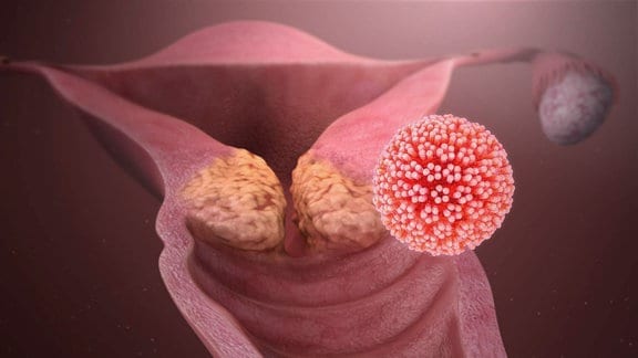 Grafische Darstellung der Gebärmutter mit einem runden Virenkörper davor.