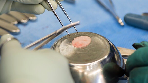 Im Operationssaal wird das gezüchtete Knorpelgewebe in Form und Größe an den Knorpelschaden im Knie angepasst. 