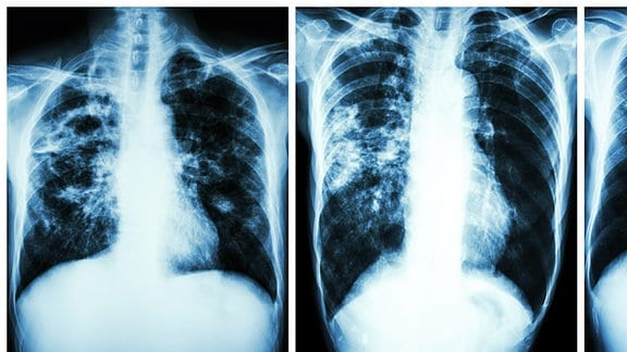 Röntgenaufnahme Brust Lunge