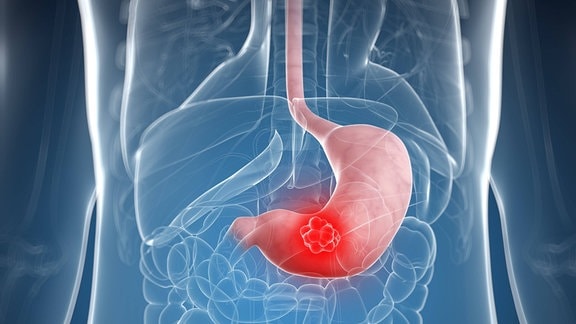 Grafik eines Körpers mit Magenkrebs.