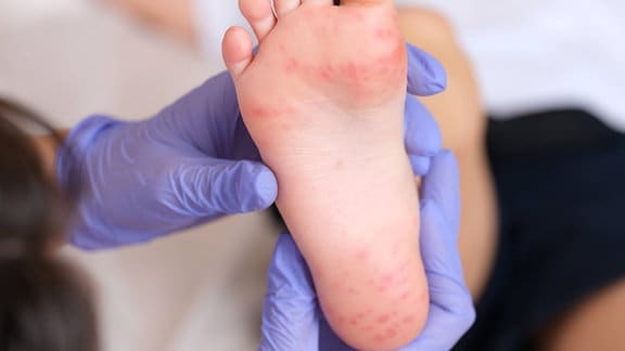 Arzt untersucht roten Ausschlag an den Füßen eines Kindes
