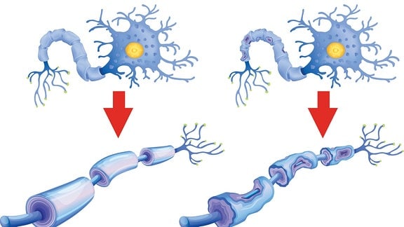 Illustration - Zerstörte Myelinschicht menschlicher Neuronen