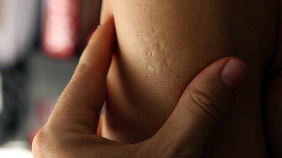 Impfmahl am Oberarm einer Frau