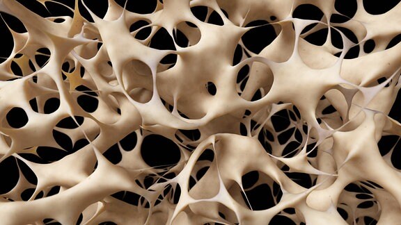 Knochen mit Osteoporose