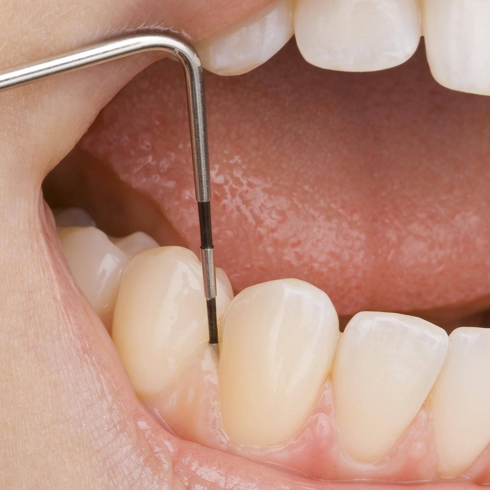 30 mit die zähne dritten Zahnzusatzversicherung für