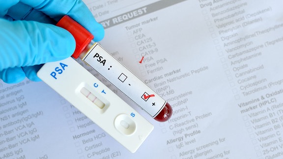 Eine behandschuhte Hand hält ein PSA Test Röhrchen und eine Testkasette. Der Test zeigt zwei rote Linien und ist positiv.