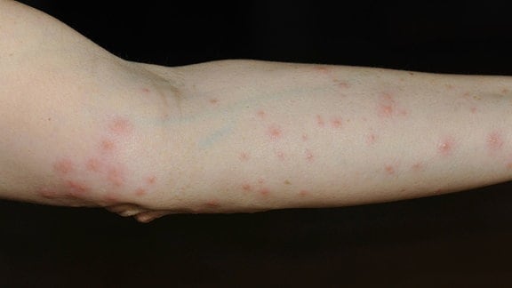 Quaddeln und Knötchen auf Arm durch eine allergische Reaktion