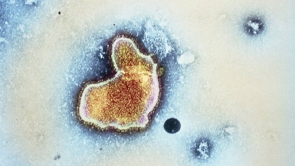 Eine in blau und orange eingefärbte elektronenmikroskoipische Aufnahme zeigt das RS-Virus, dessen Form an den Buchstaben L erinnert.