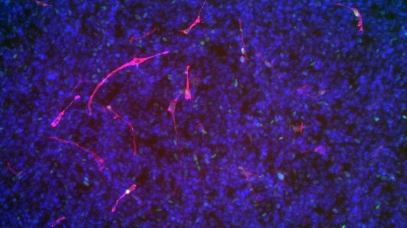 Induktion der myogenen Differenzierung und Reduktion der Zellteilung in Rhabdomyosarkom-Zellen